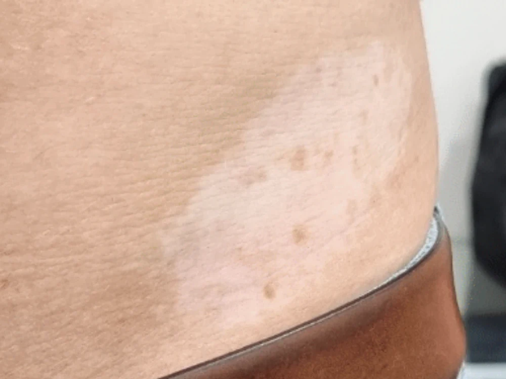 Close-up of a scar area being considered for camouflage treatment