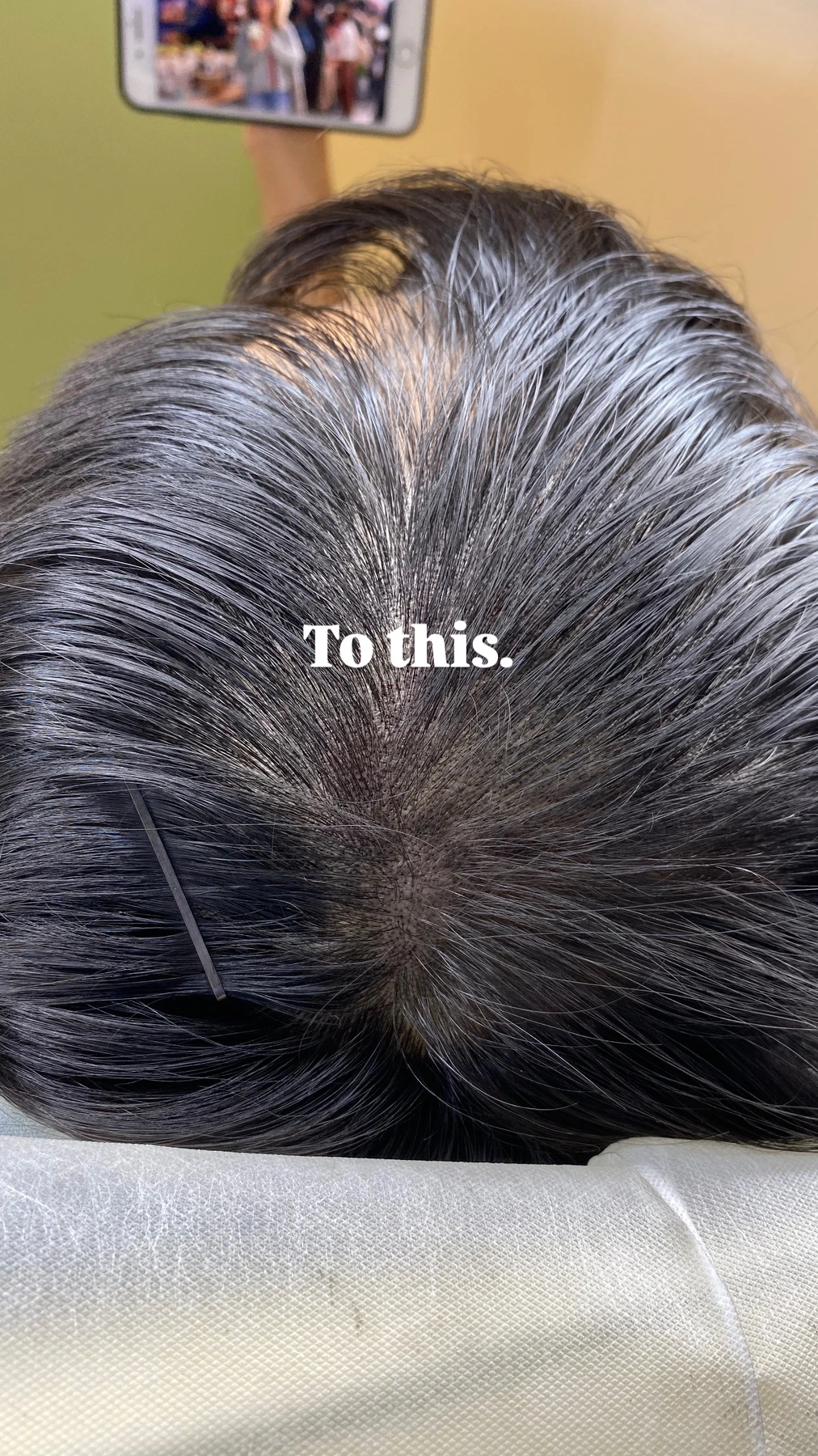 Scalp micropigmentation hair density result at Jealash