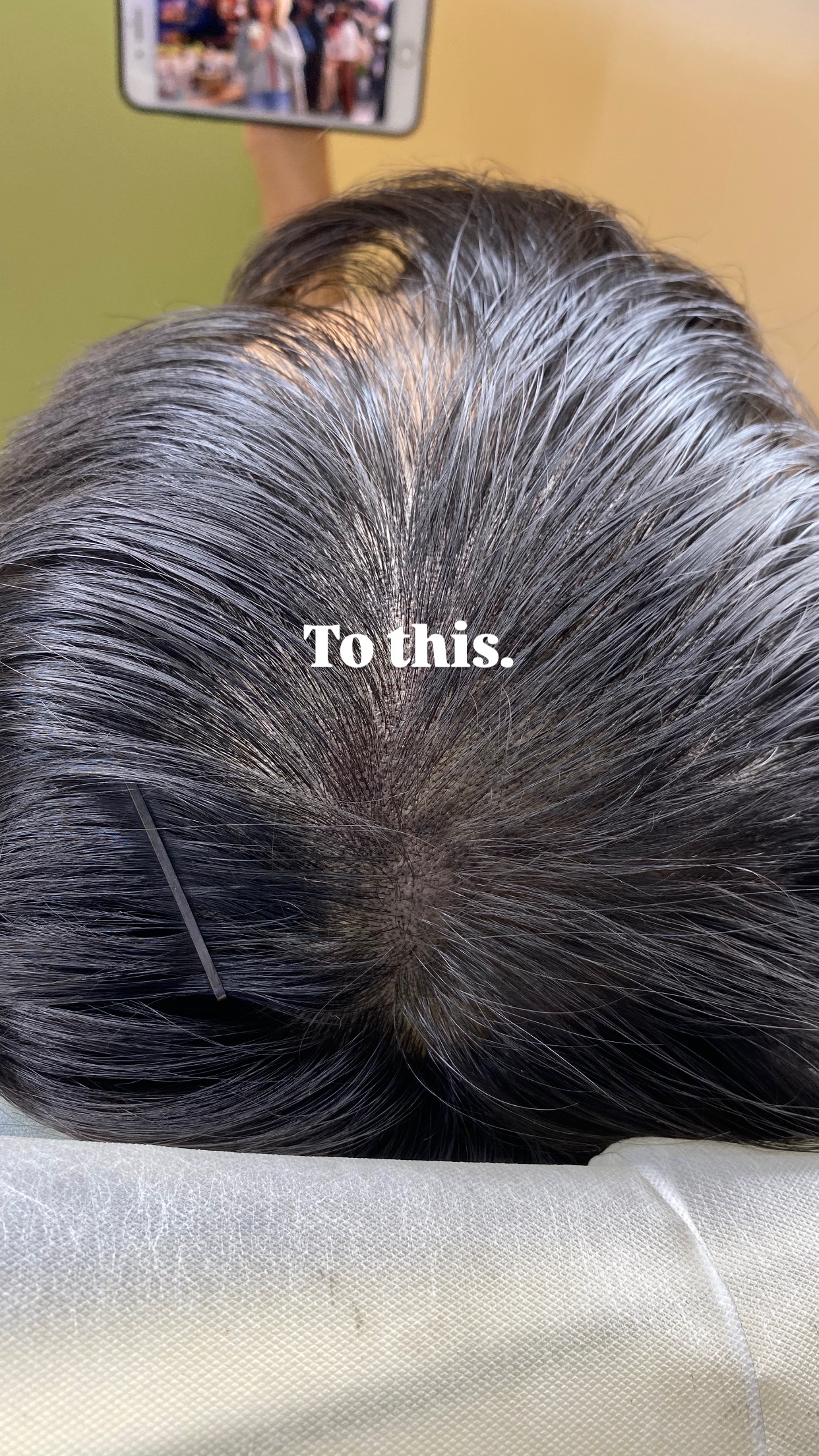 Scalp micropigmentation density result