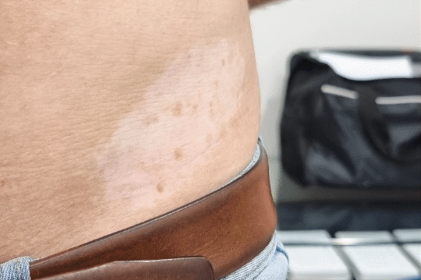 Scar reduction and skin camouflage result