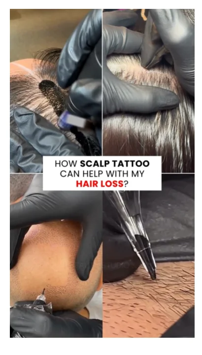 Scalp micropigmentation hairline and density result