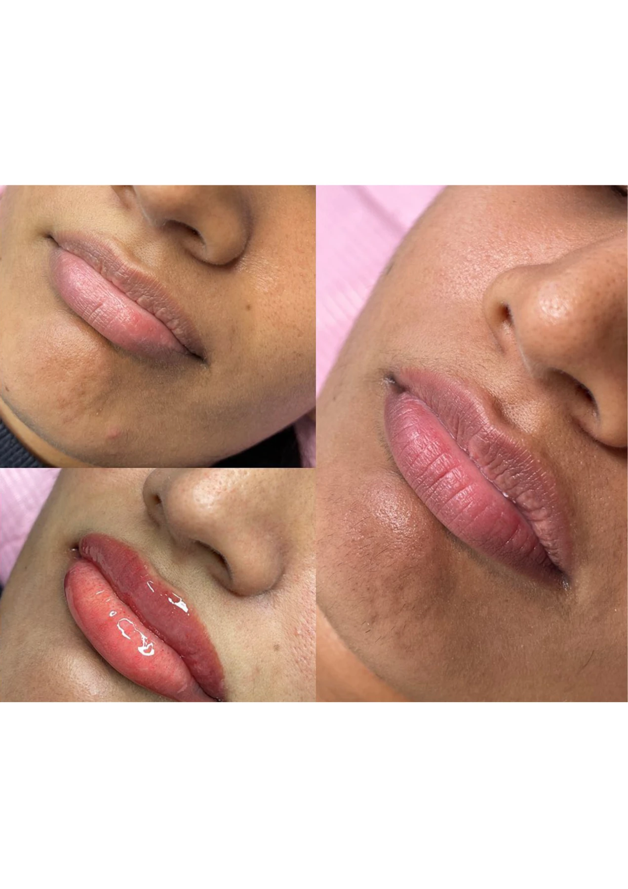 Lip blush before and after angle comparison