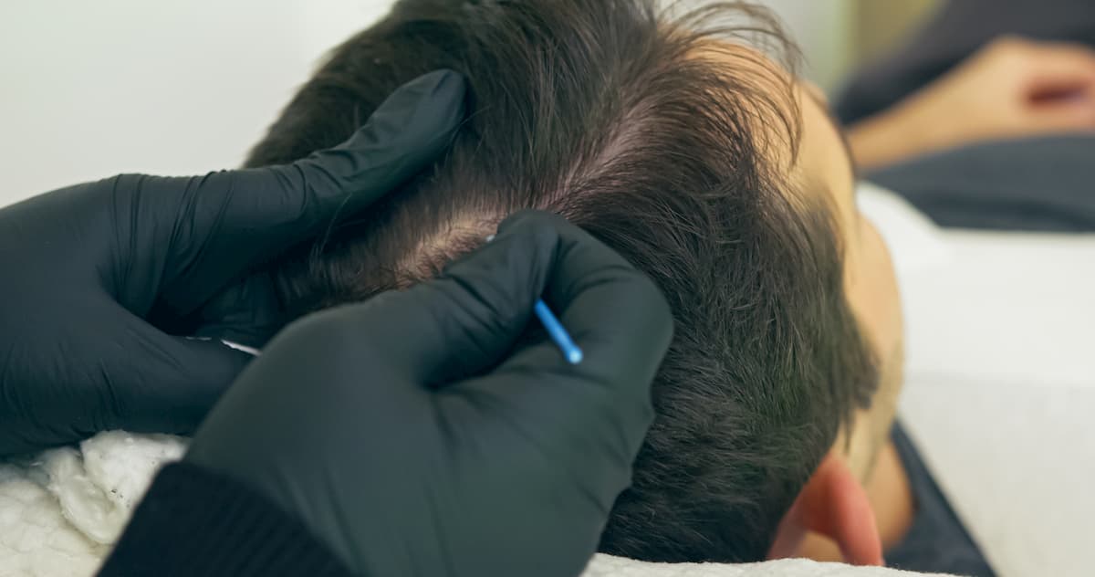 Scalp micropigmentation close-up result