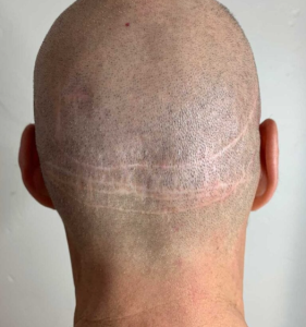 Scalp Micropigmentation (SMP) 15 4 1