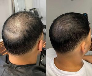 Scalp Micropigmentation (SMP) 12 DIMG 52