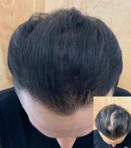 Scalp Micropigmentation (SMP) 13 WhatsApp Image 2024 02 26 at 8.02.27 PM