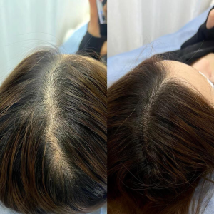 Scalp Micropigmentation (SMP) 19 aaaa 1