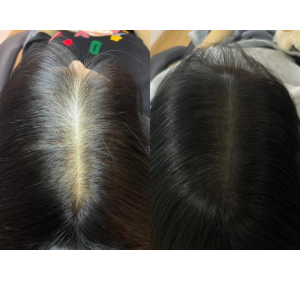 Scalp Micropigmentation (SMP) 18 aaaa 2