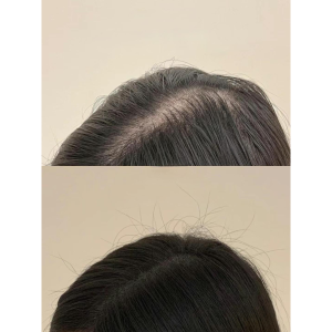 Scalp Micropigmentation (SMP) 21 aaaa 3