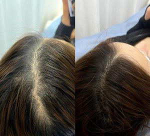Scalp Micropigmentation (SMP) 25 oYIASktAVCXAig92f3QAH8DA0fndk6ATmb20TDtplv dy aweme images q75 e1710574987822