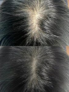 Scalp Micropigmentation (SMP) 20 okcEAgtzDEIteVyAdoGrAk2djCzADhGAfAAbIgtplv dy aweme images q75